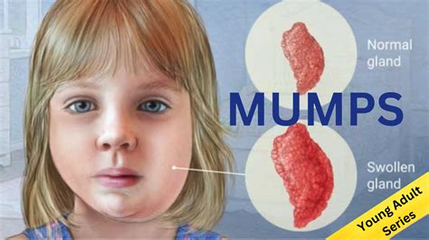 Mini Course Series - Mumps - Learning4You