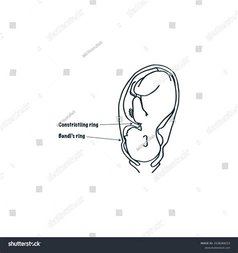 Bandls Ring Constriction Ring Obstetric Drawing Stock Vector (Royalty ...