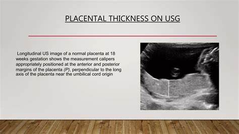 Placenta types and grading | PPTX