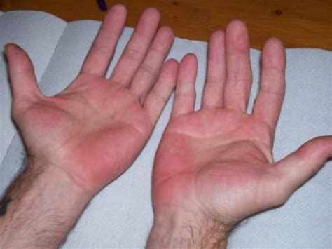 Palmar erythema: Causes, symptoms, and treatment | હથેળીઓ લાલ રહેતી હોય ...