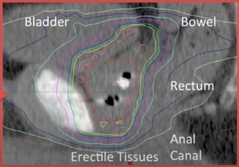 Prostate Radiation Simulation 的图像结果