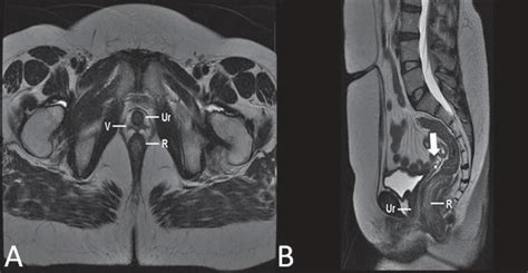 Vulvar Cyst Ct