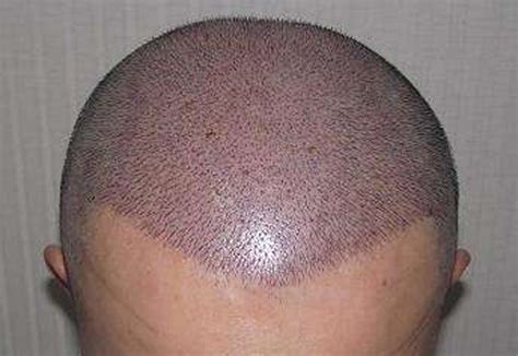 FUE植发后取发区疤痕掩饰+头顶稀疏加密典型案例-蜜颜优惠