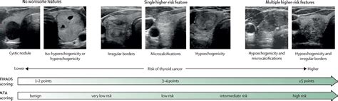 Thyroid Nodules Biopsy