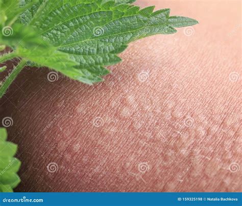 Stinging Nettle Lying on Irritated Human Skin Covered with Small ...