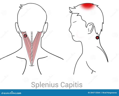 Splenius 的图像结果