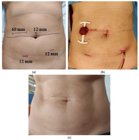 Hand-Assisted Laparoscopic Rectal Resection—Experience of a Tertiary ...