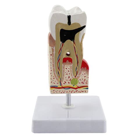 Qhyxt Educational Model Teeth Decay Amplification Dental Caries ...