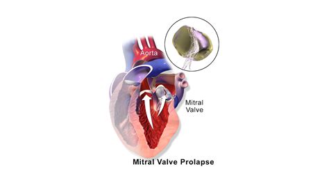 How To Control Mitral Valve Prolapse at George Buttenshaw blog