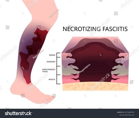 Necrotizing Fasciitis Diagram Necrotizing Fasciitis: Pathogenesis And
