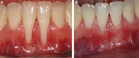 Gum Disease Treatment Tirupati | Stop Bleeding Gums