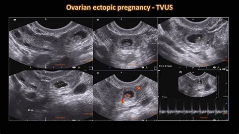 Ovarian Ectopic Pregnancy Ultrasound