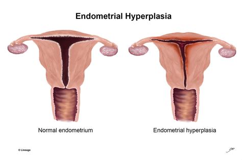 Image result for Hyperplastic Endometrium