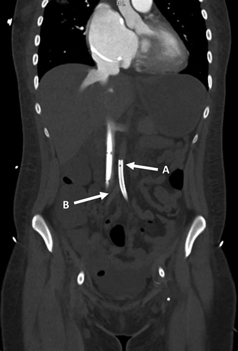 Image result for Contralateral Extremity