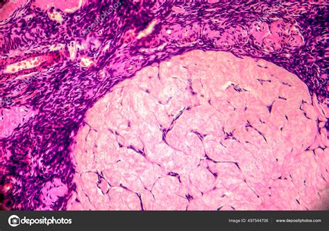 Quiste Ovárico Micrografía Ligera Foto Bajo Microscopio Fotografía ...