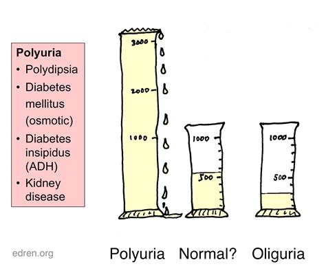 Anuria Vs Oliguria