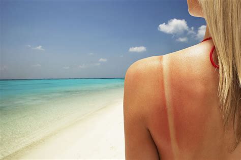 Why Does Sunburn Itch, Severe, Unbearable & Treatment of Itchy Sunburn - American Celiac