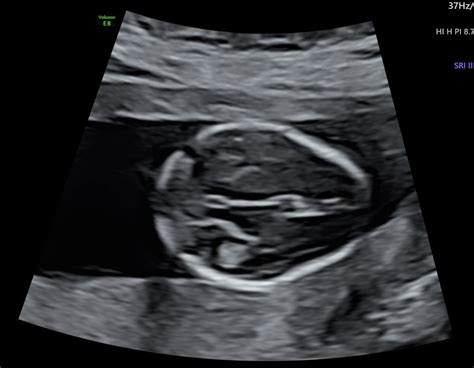 Nuchal Fold Ultrasound