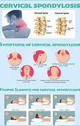 Image result for cervical spondylosis