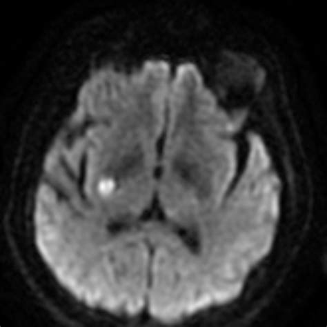 Neuroanatomy Glossary: Internal Capsule Stroke - Posterior Limb | ditki medical & biological ...