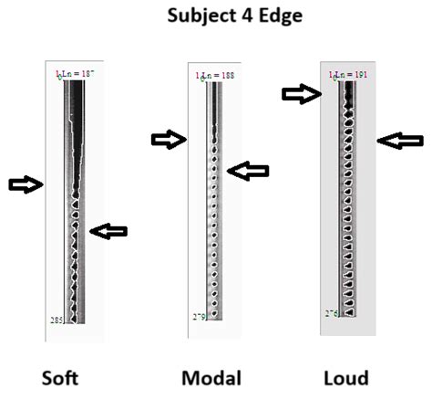 Simultaneous High-Speed Video Laryngoscopy and Acoustic Aerodynamic ...