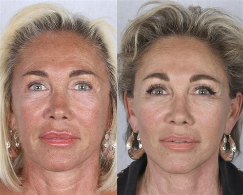 What Is Endoscopic Forehead Lift at Stanley Blake blog