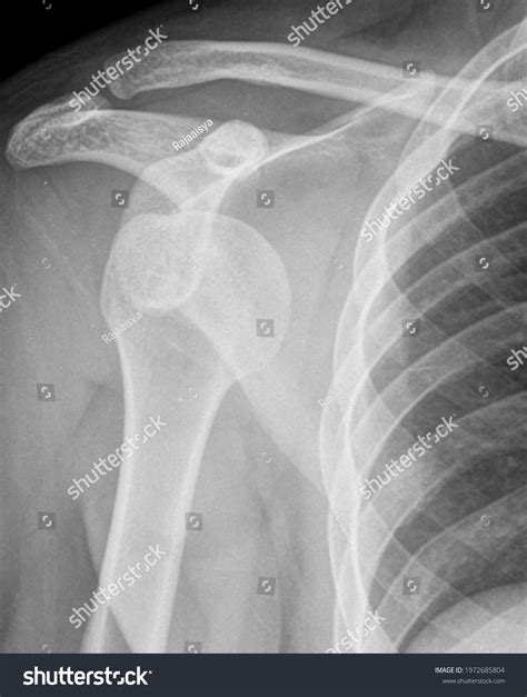 53 Anterior Shoulder Dislocation Images, Stock Photos & Vectors | Shutterstock