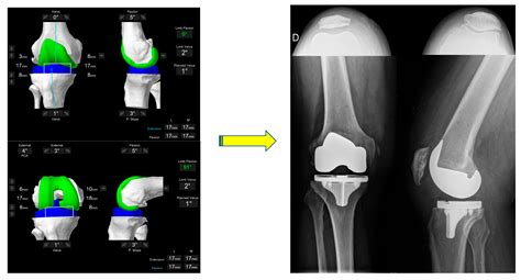 Functional Alignment Philosophy in Total Knee Arthroplasty—Rationale ...