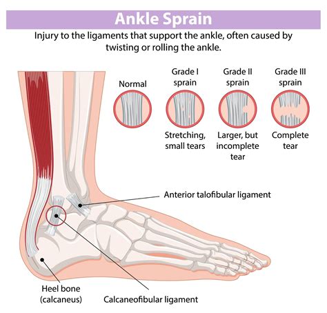 Ankle Sprain Mechanism Of Injury