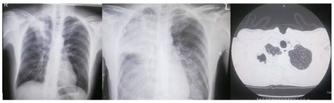 A Fatal Case of Pseudomonas aeruginosa Community-Acquired Pneumonia in an Immunocompetent ...