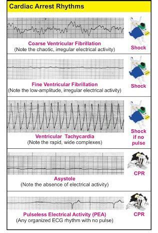 shockable and non shockable rhythms - Charles Vance