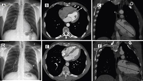 Boot-Shaped Heart After Robotic Coronary Assist Bypass Surgery | JACC: Cardiovascular Imaging