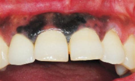 Black Spots On Gums Under Teeth at Loren Bona blog