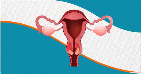 What Is Cervical Cancer - Cureka