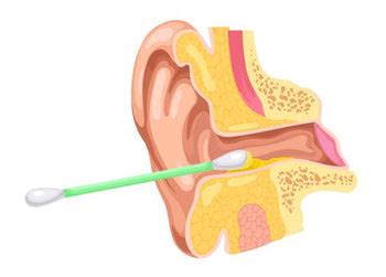 Ear Wax Buildup: Causes, Symptoms, and Safe Removal Techniques ...
