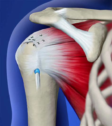 Image result for Rotator Cuff Repair Photo