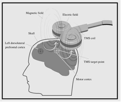 Image result for RTMS Side Effects