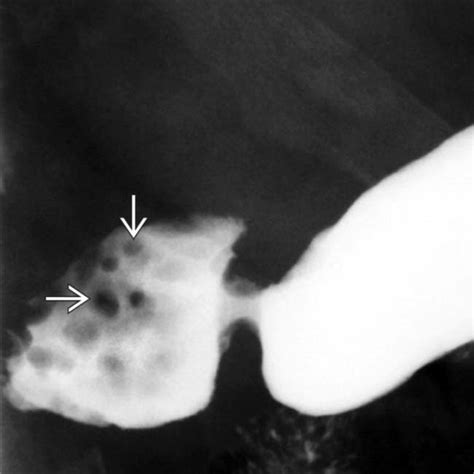 Kuvatulokset haulle brunner syndrome