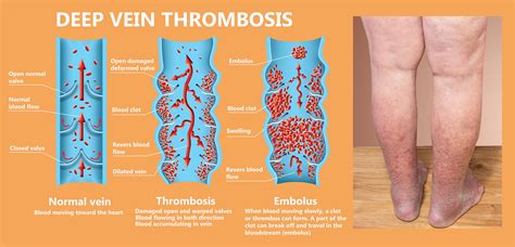 When Blood Clots and DVT Become Dangerous to Your Health | DVT Treatment
