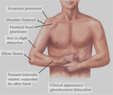 Shoulder Dislocation Contortion 的图像结果