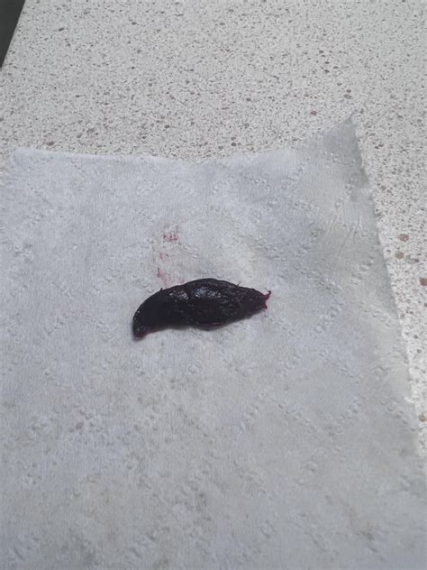 External Hemorrhoid With Blood Clot Thrombosed External Hemorrhoid