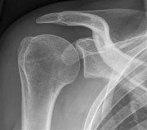Image result for Subacromial Decompression Rotator Cuff Repair