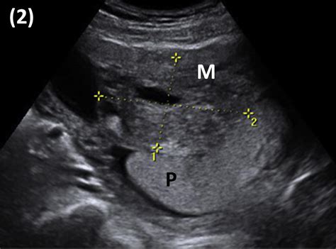 Placenta increta after high-intensity-focused ultrasound for the treatment of a uterine ...