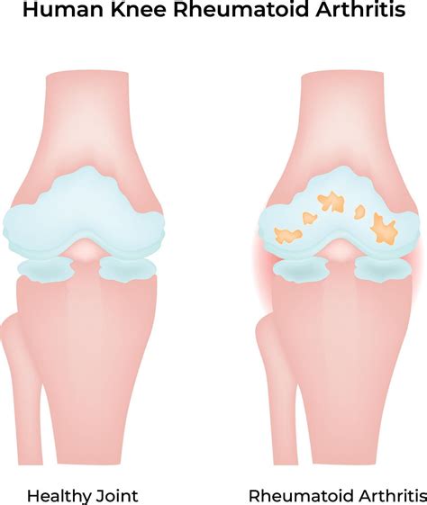 Human Knee Rheumatoid Arthritis Science Design Illustration Diagram 54082001 Vector Art at Vecteezy
