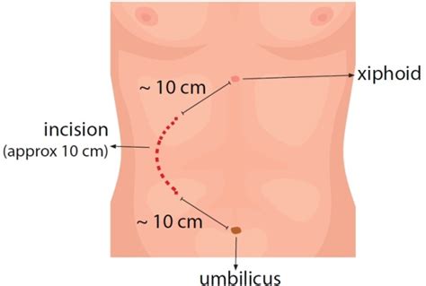 Image result for Flank Incision Nephrectomy