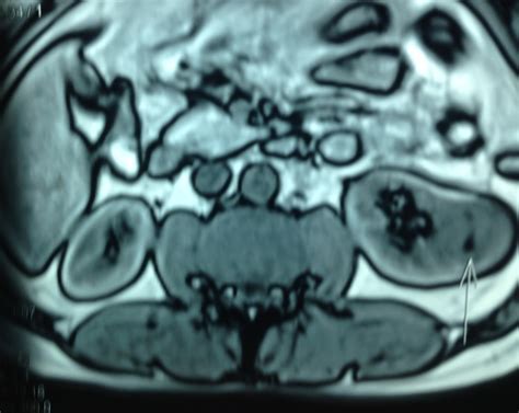 VIETNAMESE MEDIC ULTRASOUND: CASE 457: AML KIDNEY TUMOR, Dr PHAN THANH HẢI, Dr NGUYỄN HOÀNG ĐỨC ...