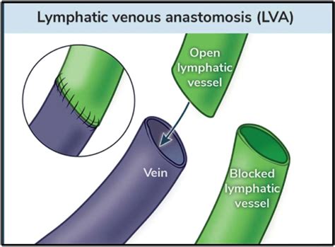 Illustration Of Lymphovenous Bypass Surgery