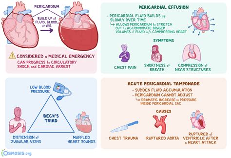 Pericardial Tamponade: What Is It, Causes, Pericardial Effusion | Osmosis
