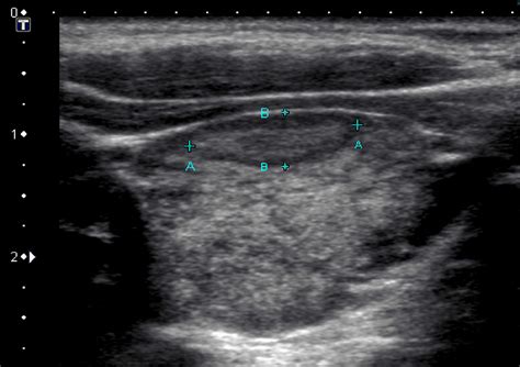 Ultrasound vs sonogram - bezyqatar