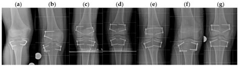 Temporary Proximal Tibial Epiphysiodesis for Correction of Leg Length ...